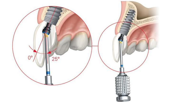 Implant Image